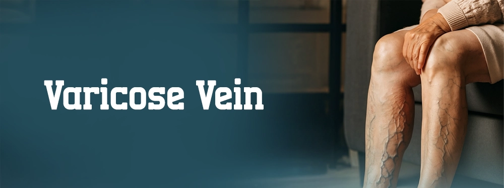 varicose veins treatment
